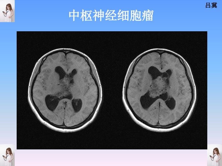 医影在线-cns疾病影像图库_第5页