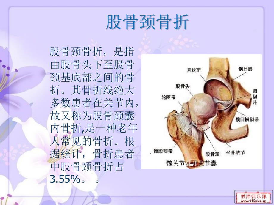 《股骨颈骨折幻灯》ppt课件_第1页