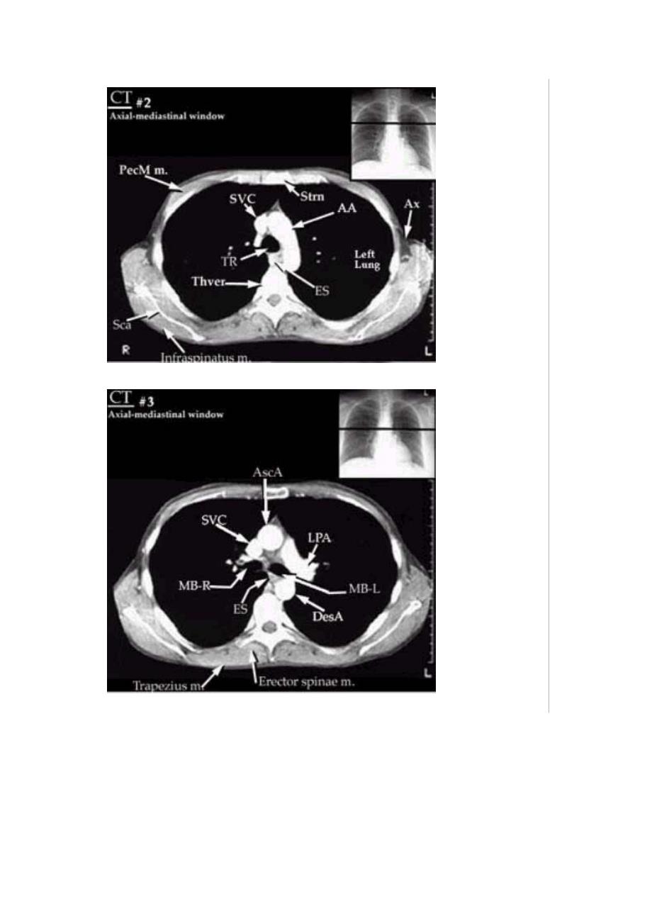 ct断层解剖图胸部-心脏_第2页