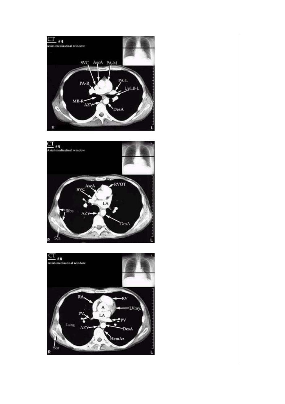 ct断层解剖图胸部-心脏_第3页