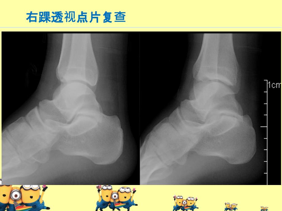 跟距骨桥病例介绍_第3页