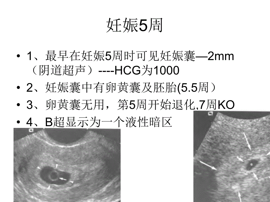 b超对妊娠的诊断_第2页