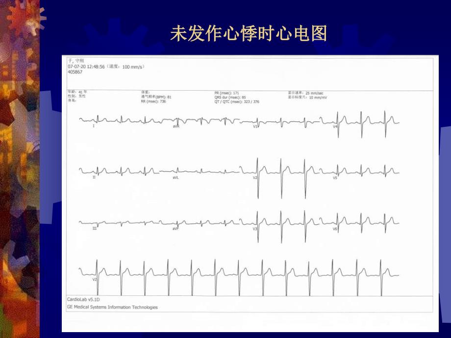 房室结折返心动过速中少见现象的分析教学课件_第4页