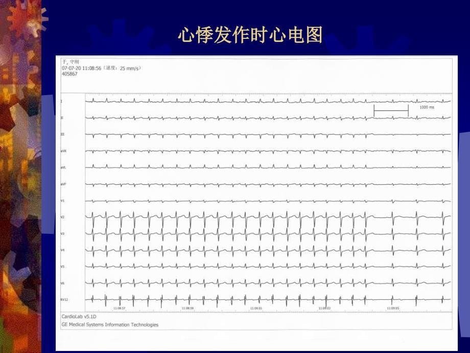 房室结折返心动过速中少见现象的分析教学课件_第5页