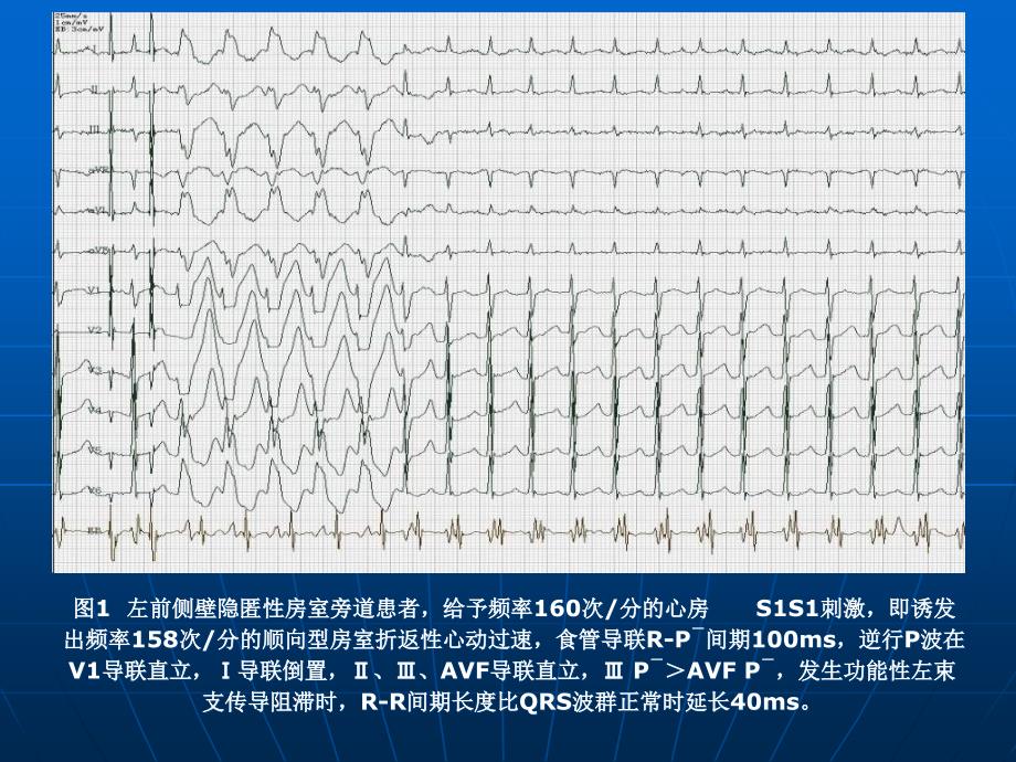 房室折返心动过速周期长短变化现象_第4页