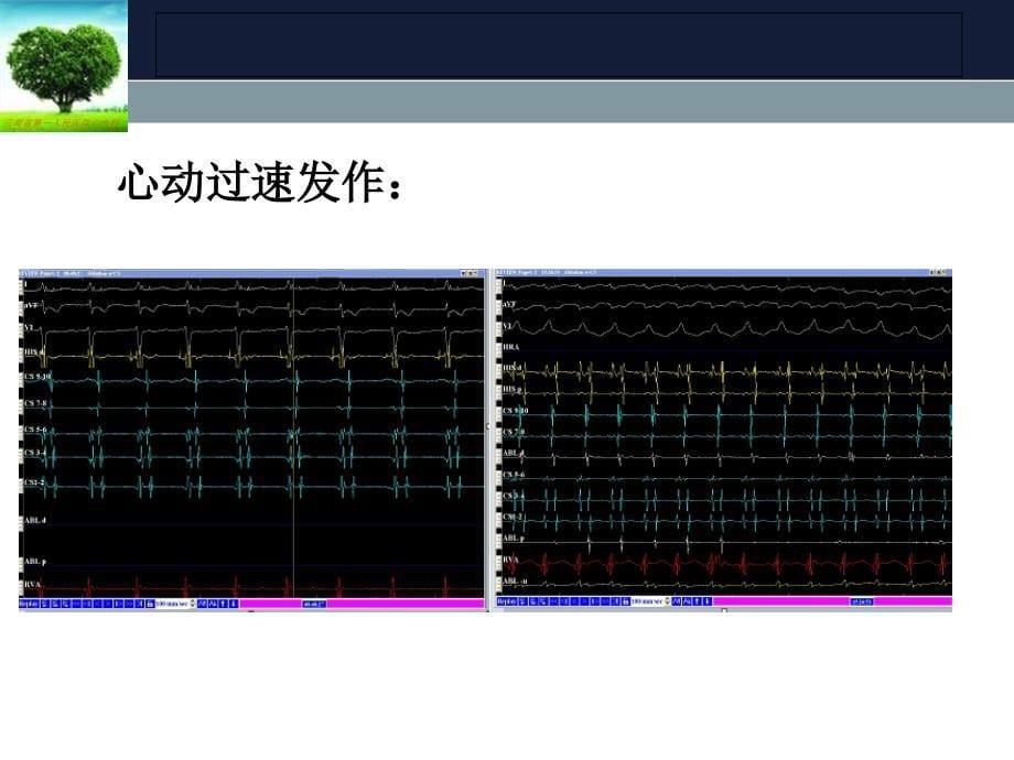 三维系统引导下心中静脉旁道射频消融一例_第5页