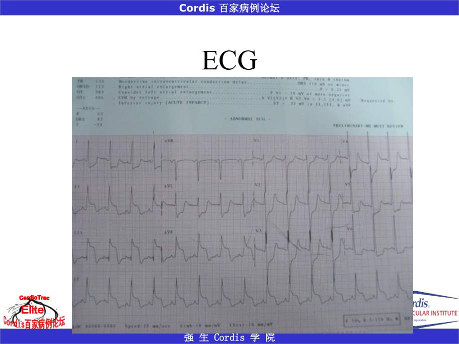 急诊pci-多支血管病变患者罪犯血管的判断_第3页