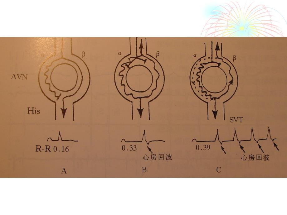 房室结折返性心动过速慢径消融_第3页