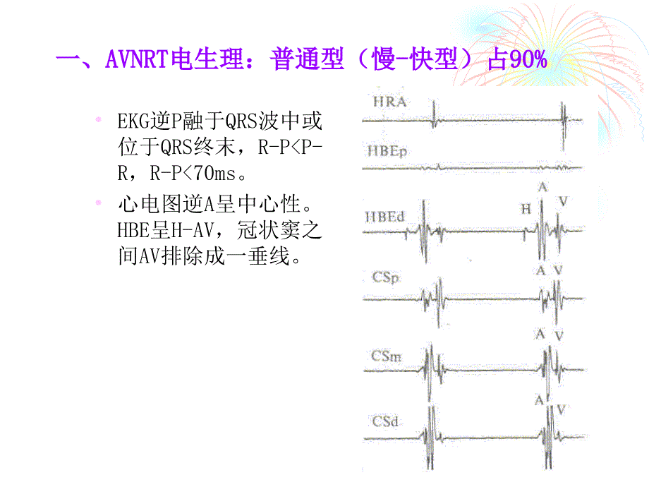 房室结折返性心动过速慢径消融_第4页