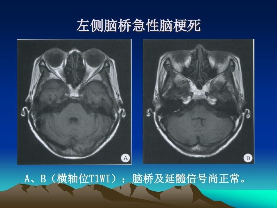 神经内科ct和mr影像_第5页