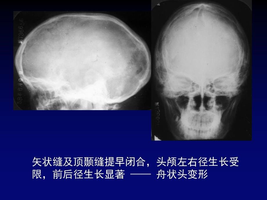 颅脑先天畸形影像系_第5页