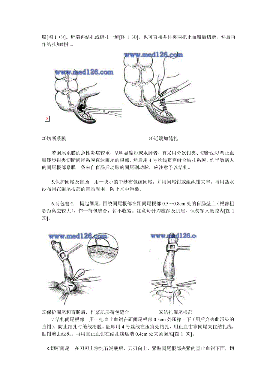 阑尾炎切除术_第3页