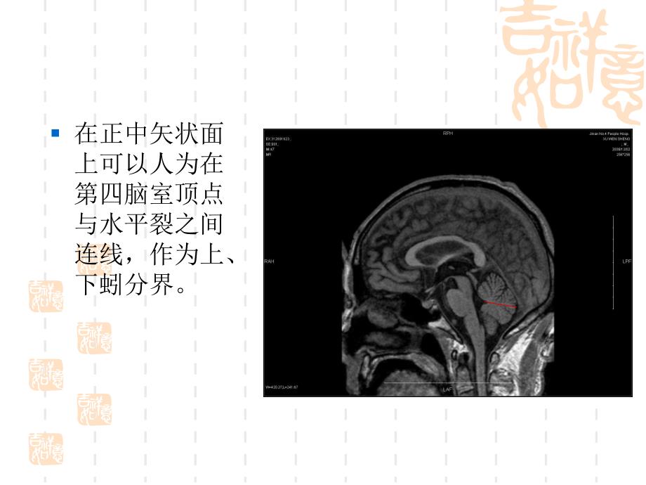 小脑大体及mr断层解剖_第3页