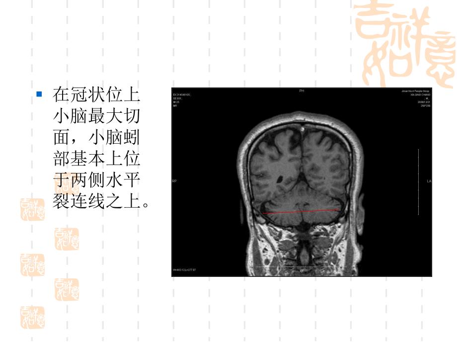 小脑大体及mr断层解剖_第4页