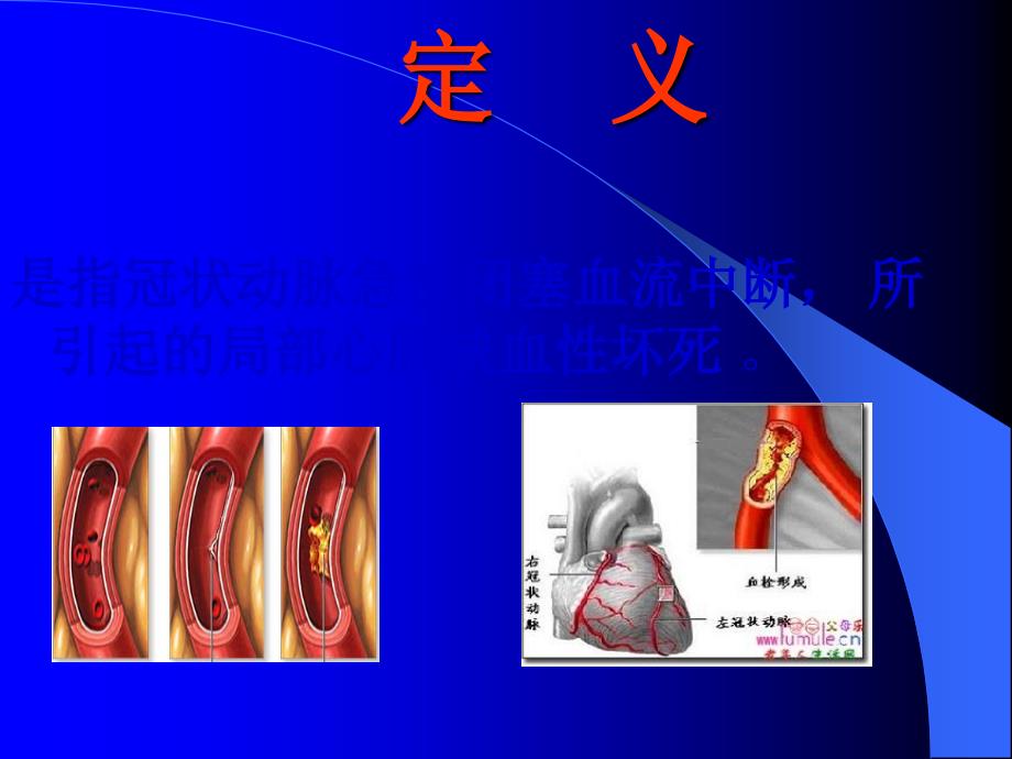 关于急性心肌梗死的评估与抢救配合ppt课件_第2页