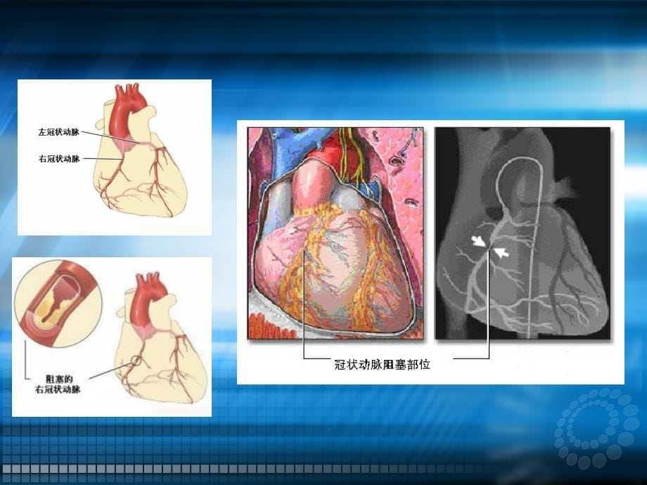 冠心病二级预防ppt课件_第5页
