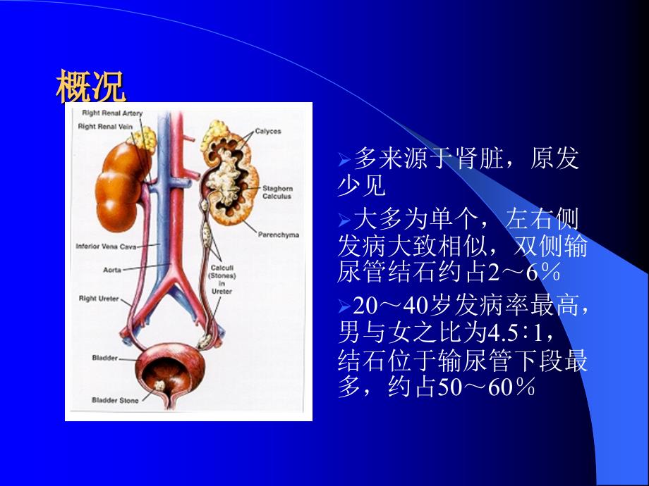 多层螺旋ct在输尿管结石诊断中的应用ppt课件_第2页