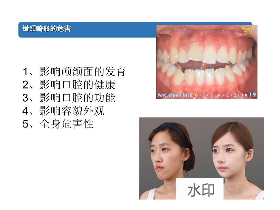 错颌畸形对美学的影响ppt课件_第4页