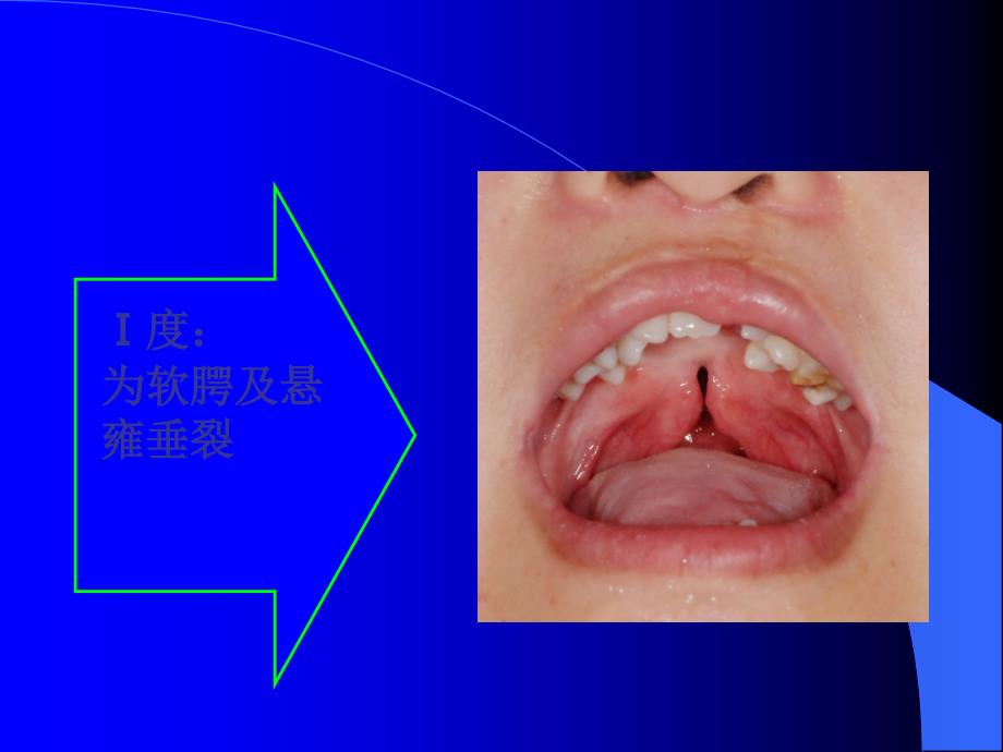 教学---唇腭裂、牙槽突裂、鼻唇畸形护理ppt课件_第4页