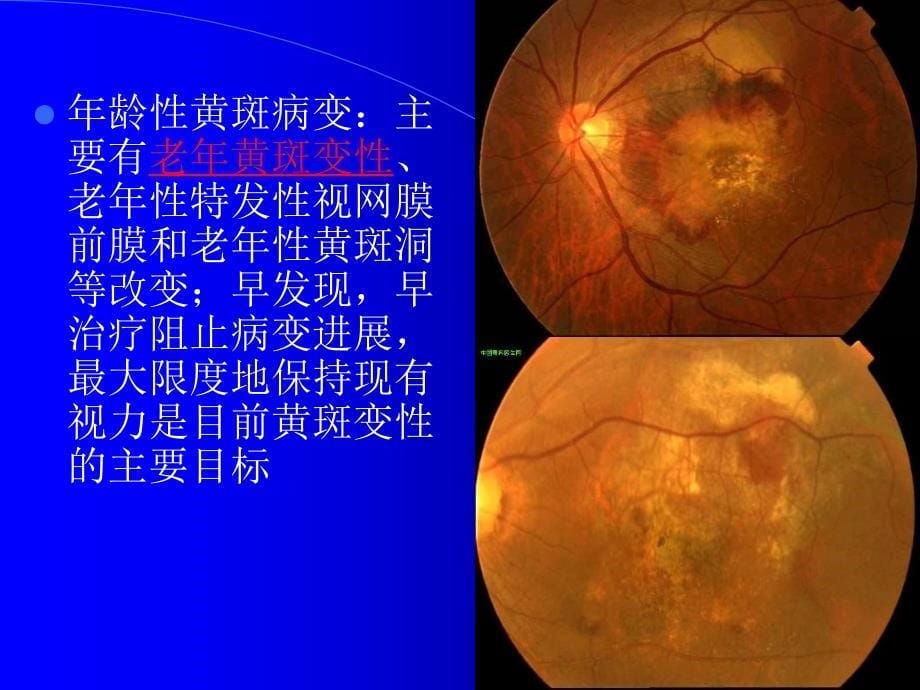 复方血栓通胶囊眼科幻灯片--基药ppt课件_第5页