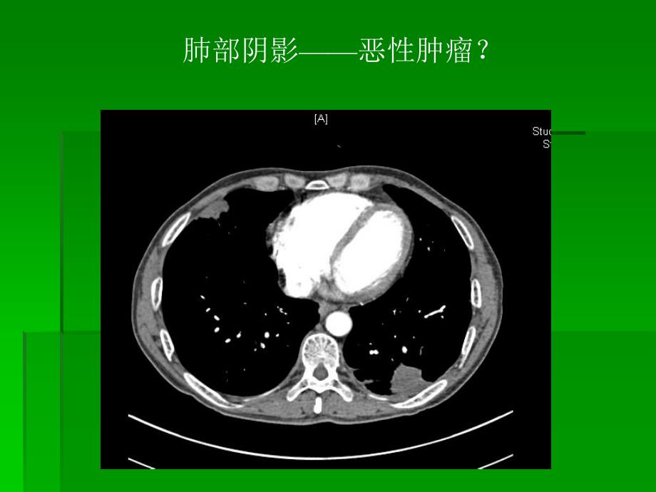 恶性肿瘤合并肺栓塞临床实践ppt课件_第4页