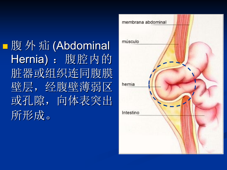 腹股沟疝(Inguinal Hernia).ppt_第3页