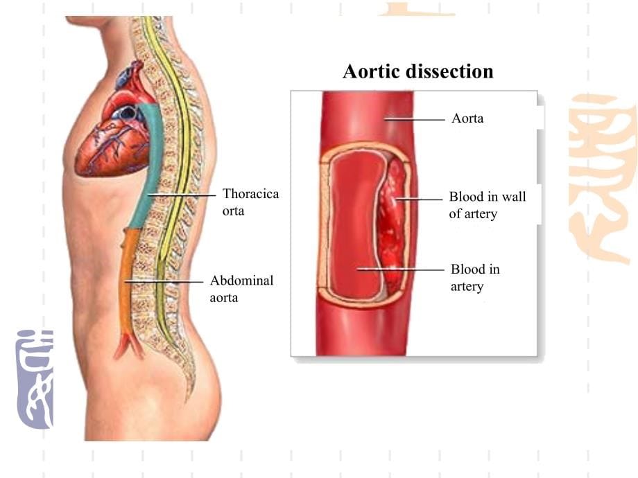 《p主动脉夹层》ppt课件_第5页