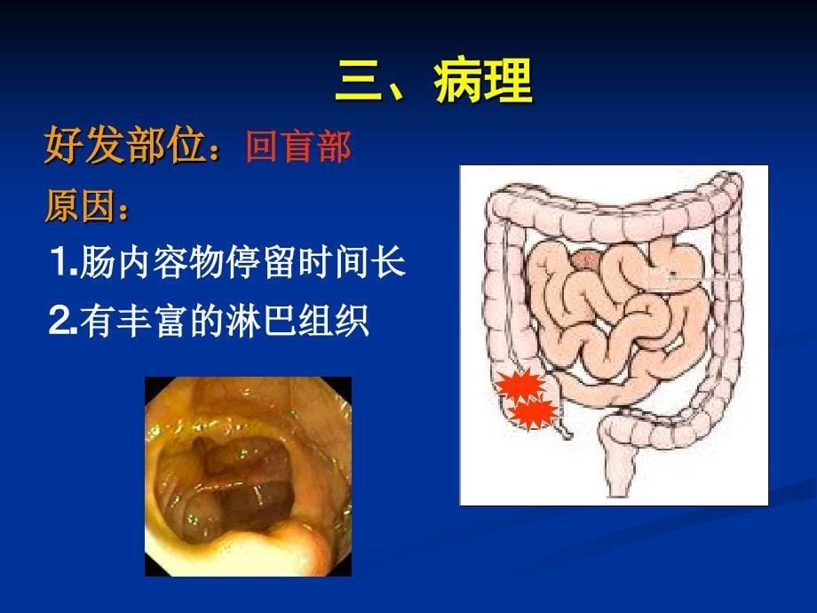 肠结核病人的护理_第5页