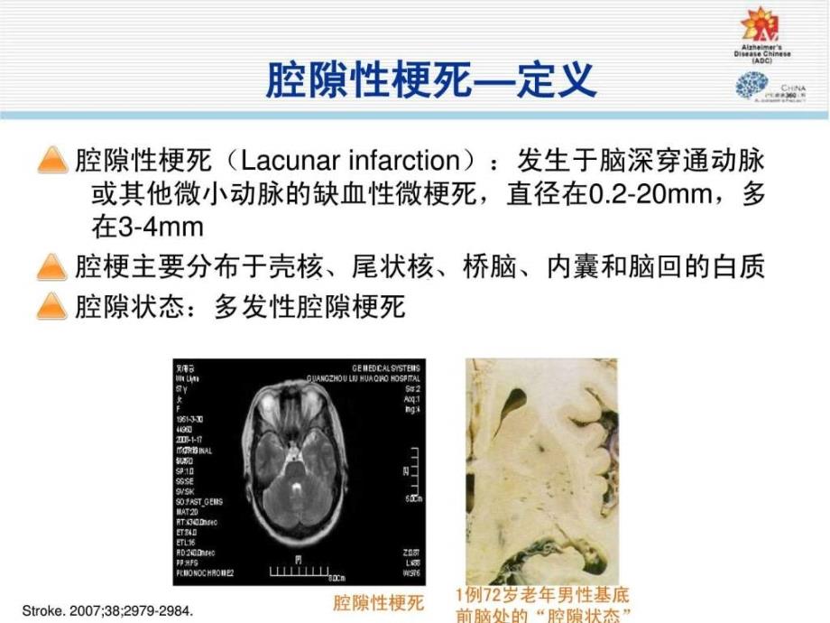 《腔梗与认知》ppt课件_第4页