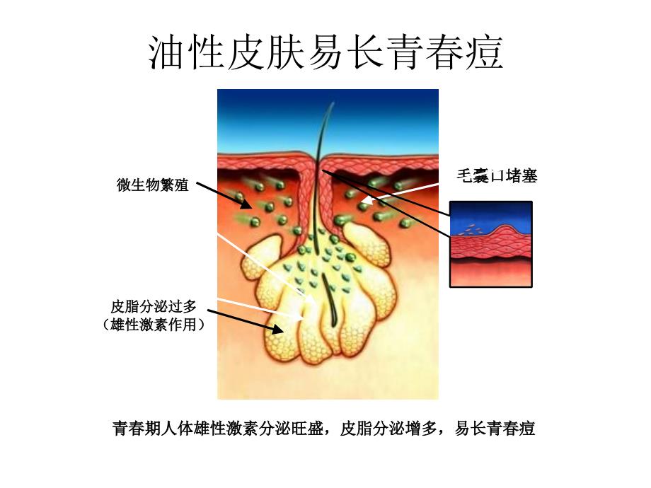 油性皮肤与痤疮ppt课件_第2页