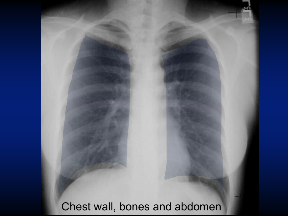 医学ppt--basicchestxraymodadam_第4页