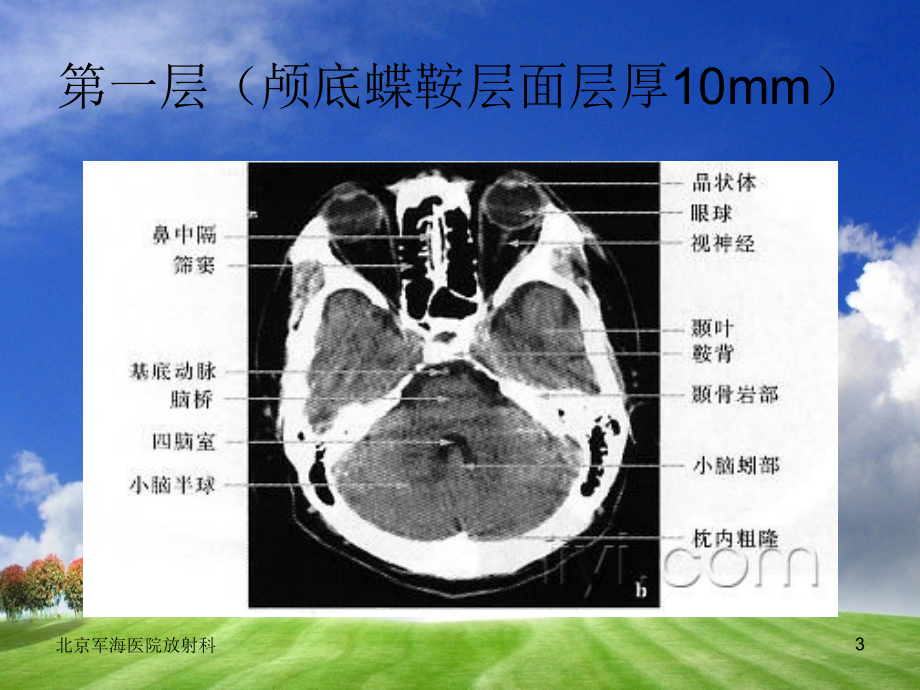 《颅脑ct影像学》ppt课件_第3页