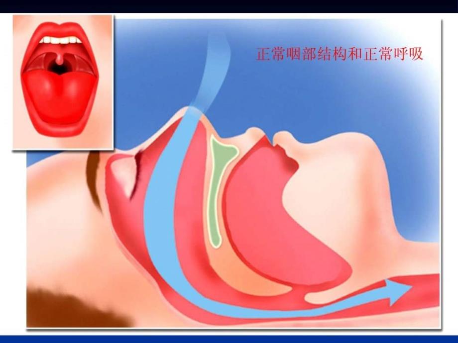 i阻塞性睡眠呼吸暂停综合征的诊治_第2页