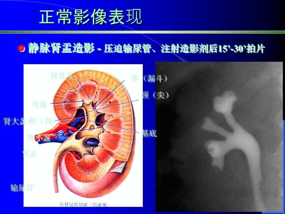 肾教学ppt课件_第5页