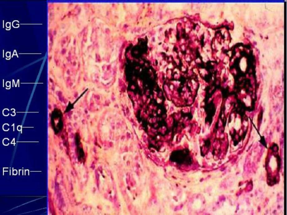 《狼疮肾炎分类》ppt课件_第4页