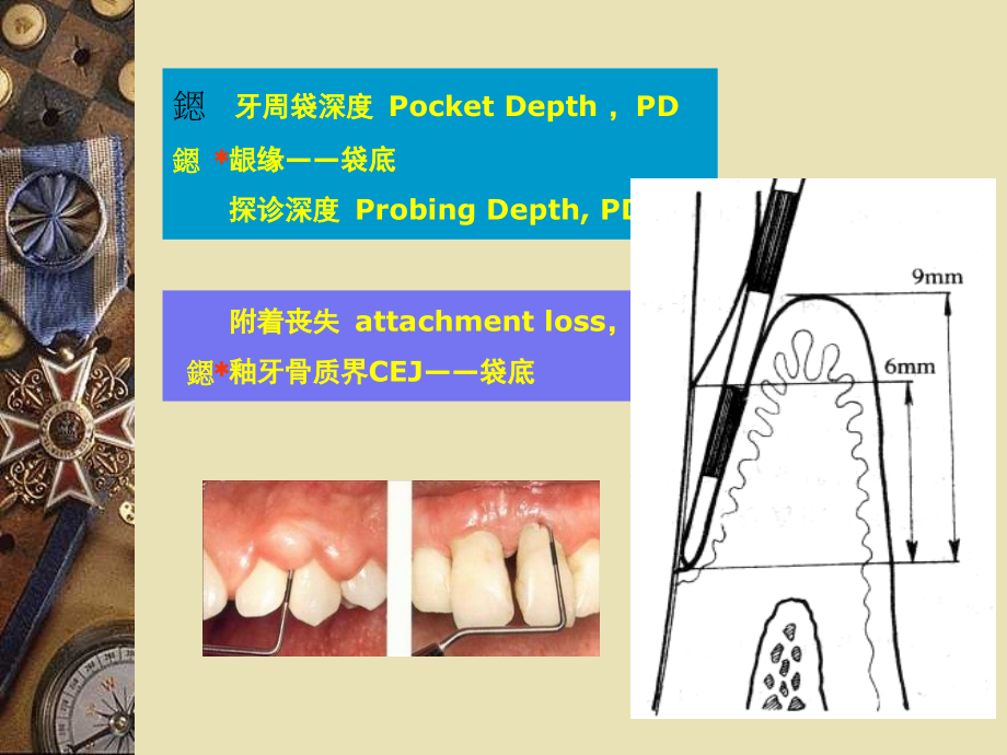 牙周病临床病理ppt课件_第4页