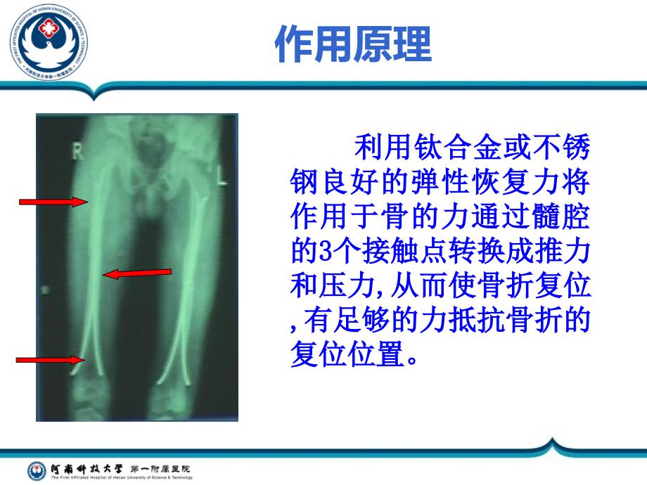 弹性髓内钉术后患者的护理ppt课件_第3页