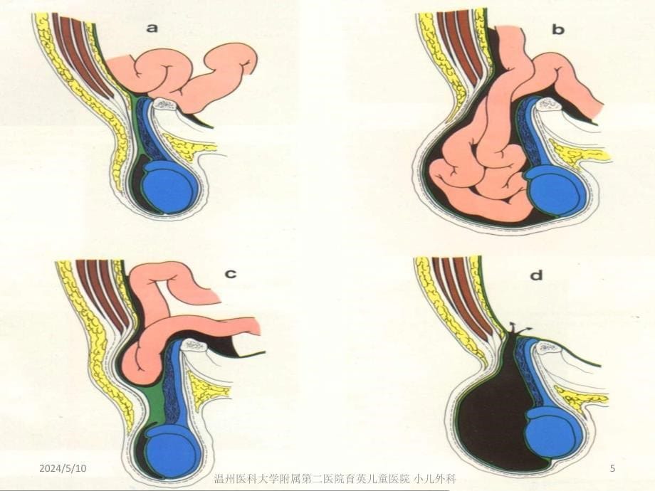 腹股沟及阴囊急诊ppt_第5页