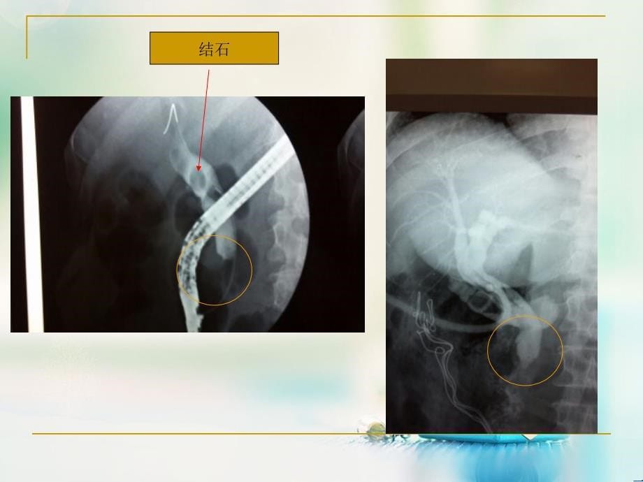 《胆总管结石相关护理》ppt课件_第5页