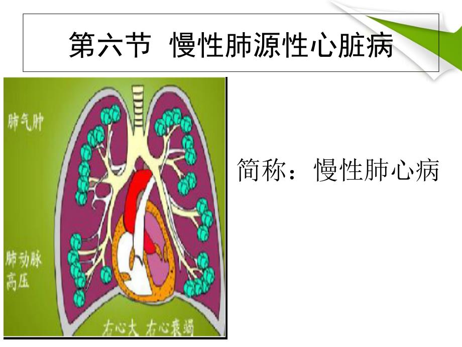 《肺心病(成大)》ppt课件_第2页