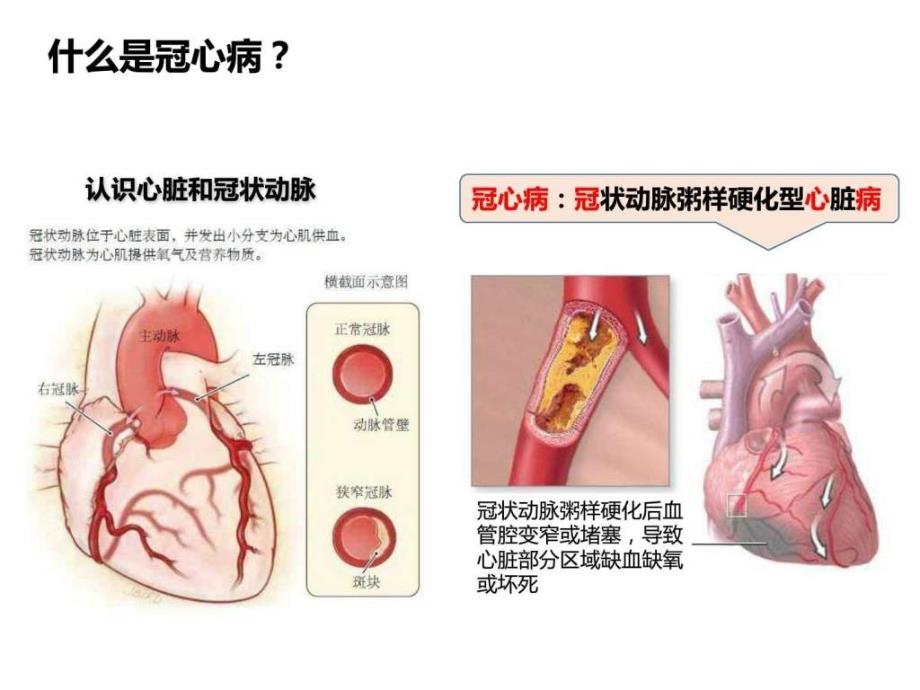 防治高血压、冠心病,保护好您身体的发动机-患教v_第4页