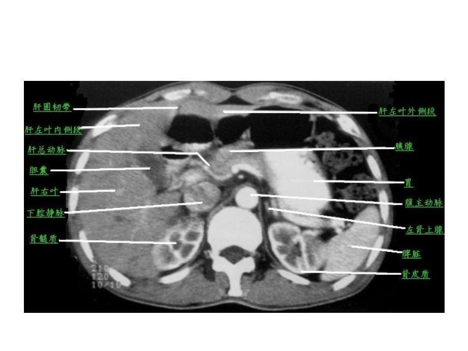 《腹部层面解剖》ppt课件_第5页