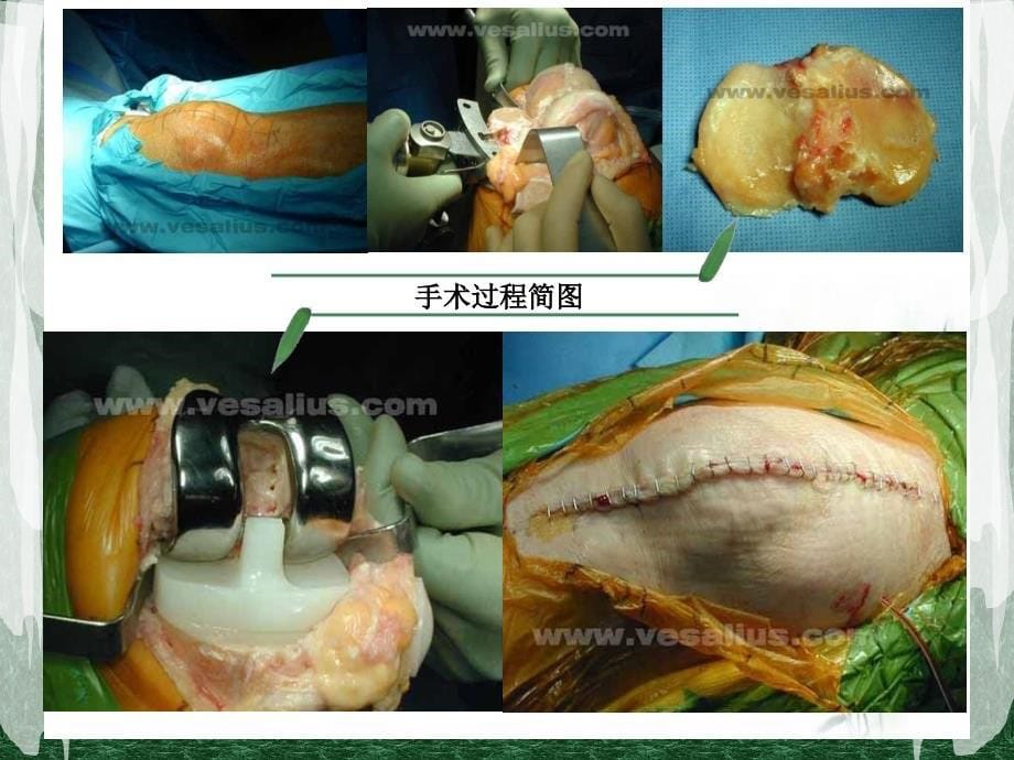 《全膝关节置换术后护理》ppt课件_第5页