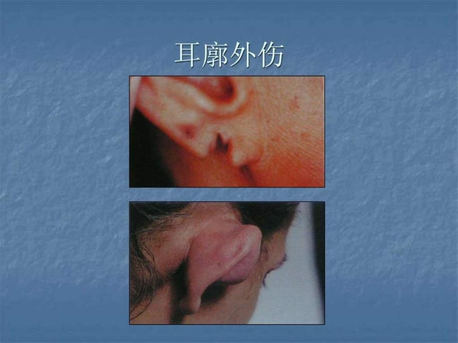 《外耳疾病》ppt课件_第2页