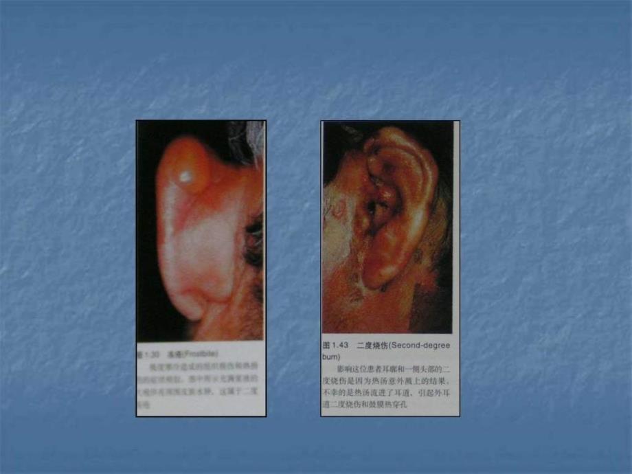 《外耳疾病》ppt课件_第3页