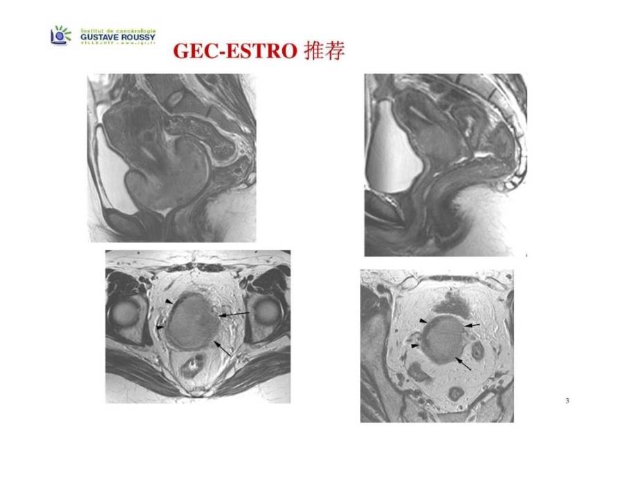 宫颈癌近距离放疗中靶区及危及器官勾画-gecestro推荐_第3页