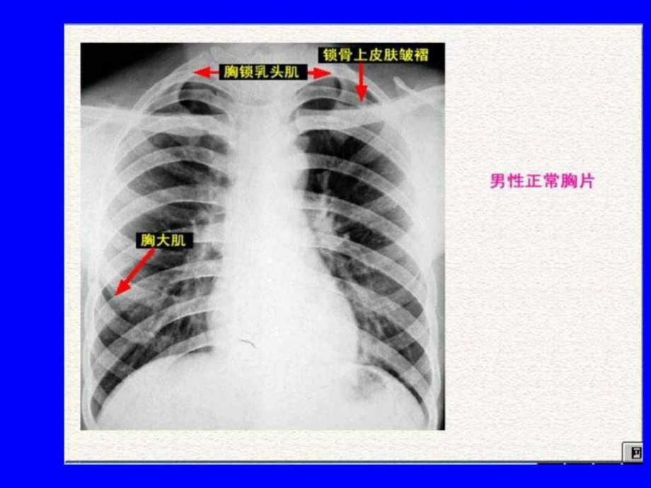 肺部正常和x线异常表现_第3页