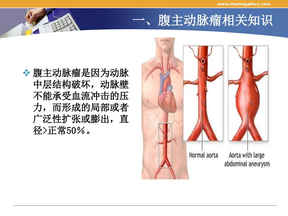 腹主动脉瘤的护理ppt_第3页