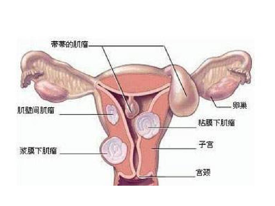 子宫肌瘤个案护理查房ppt课件_第4页