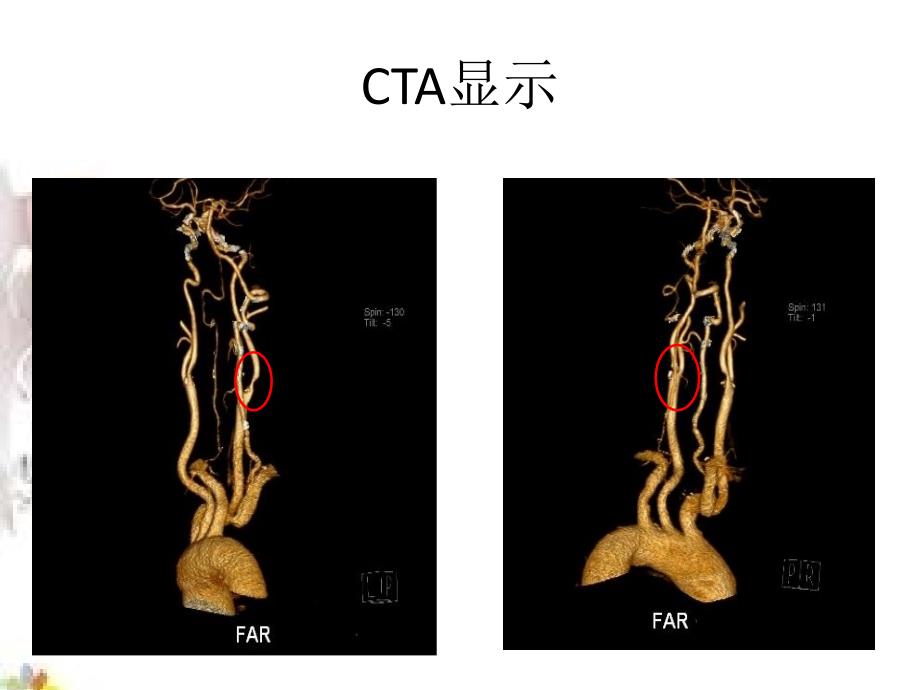 《颈动脉狭窄》ppt课件_第3页